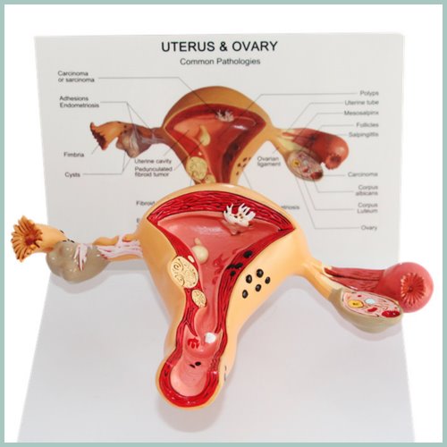 여성 자궁 및 난소 병리적 해부모형