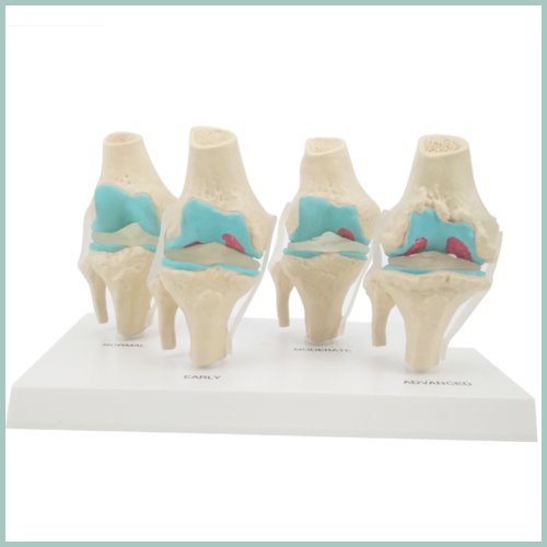 인체 무릎 관절염 4단계 모형